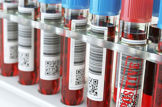 ԱՀԿ. ՄԻԱՎ-ով վարկված մարդկանց միայն 70 տոկոսը գիտի իր կագավիճակի մասին