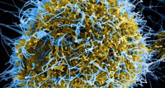 Աշխարհում երկրորդ պացիենտը բուժվել է ՄԻԱՎ-ից