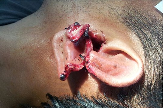 Շիրակի մարզում եղբայրը կտրել է քրոջ հեռախոսին մի քանի անգամ զանգահարած տղայի ականջը