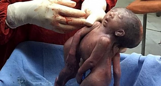 Հնդկաստանում ընդհանուր դեմքով սիամյան երկվորյակներ են ծնվե
