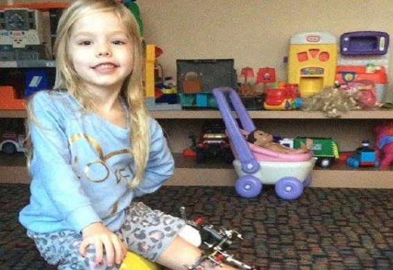 Photo. ԱՄՆ-ում ծնողները դստեր ոտքն անդամահատելու փոխարեն,նախընտրել են երկարացնել՝ օրական 3 անգամ կոտրելով ոտքը