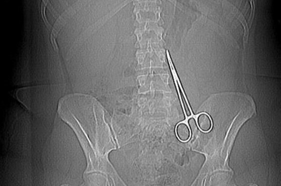 Բժիշկները թուրք կնոջ որովայնում մկրատ են մոռացել, որը հայտնաբերվել է միայն 6 ամիս անց